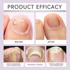 Bee Venom Nail Treatment Serum | 🔥BUY 1 GET 1 FREE🔥